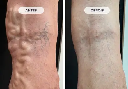 A mesma perna depois do tratamento com a Técnica ATTA