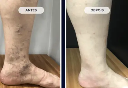 Perna com varizes antes do tratamento