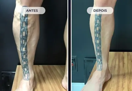 A mesma perna depois do tratamento com a Técnica ATTA