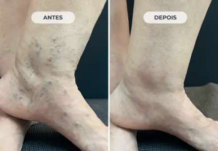 A mesma perna depois do tratamento com a Técnica ATTA